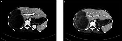 Hepatectomy and pneumectomy combined with targeted therapy for primary hepatic neuroendocrine carcinoma: Case report and review of the literature